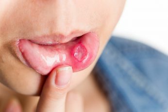 informations sur le virus de l'herpès